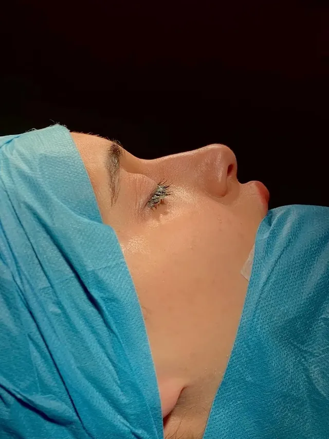 Rhinoplasty - Before