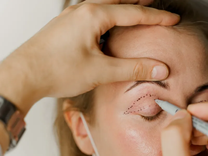 İstanbul Göz Kapağı Estetiği: Blefaroplasti Ameliyatı