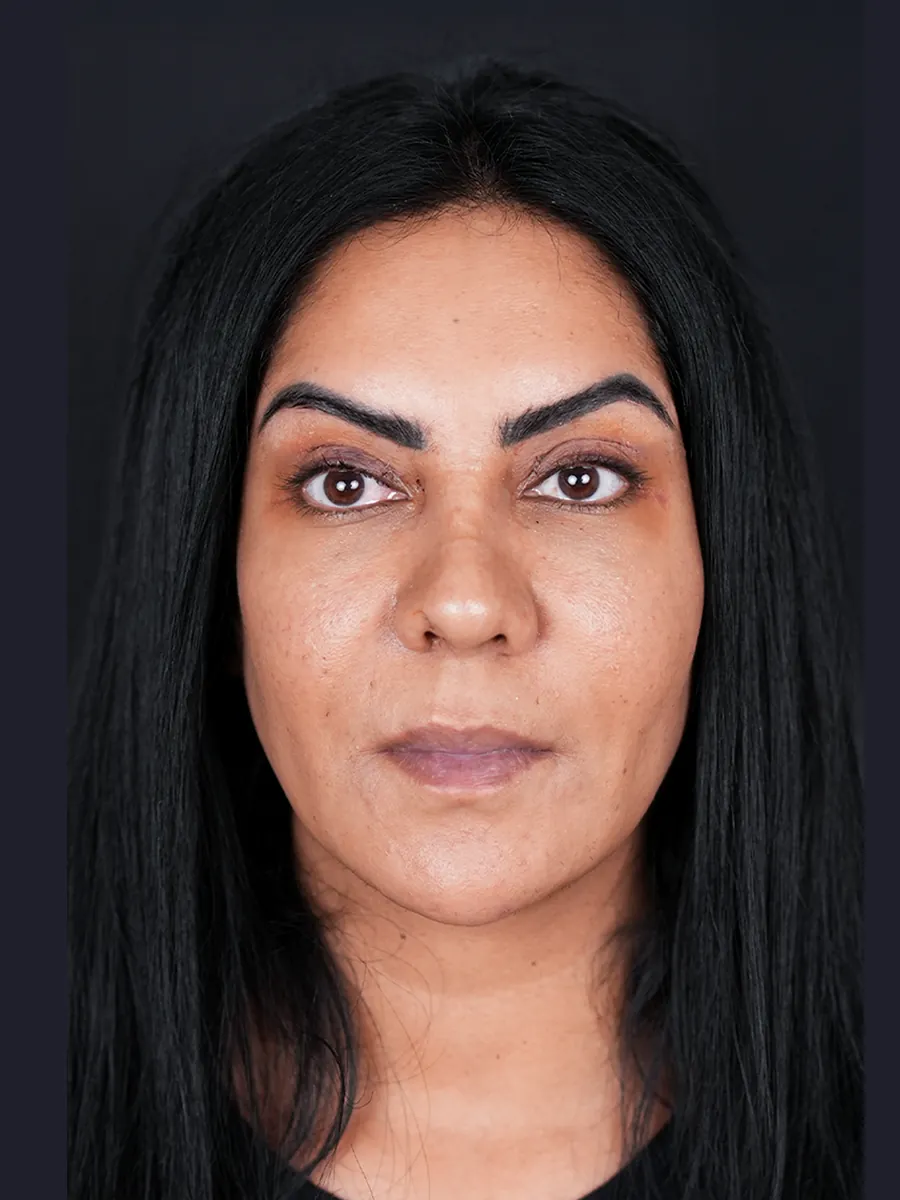 Blepharoplasty - After