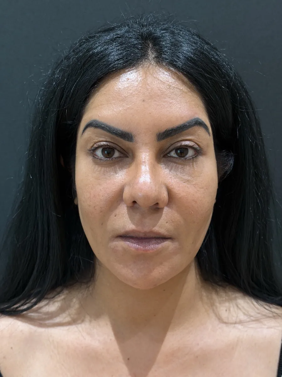 Blepharoplasty - Before