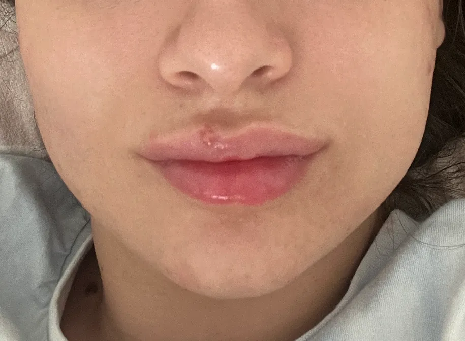 Dolgu ve Botoks - After