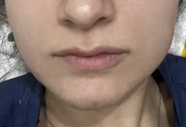 Dolgu ve Botoks - Before