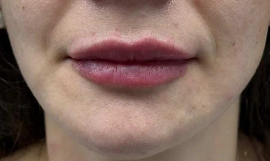 Dolgu ve Botoks - After