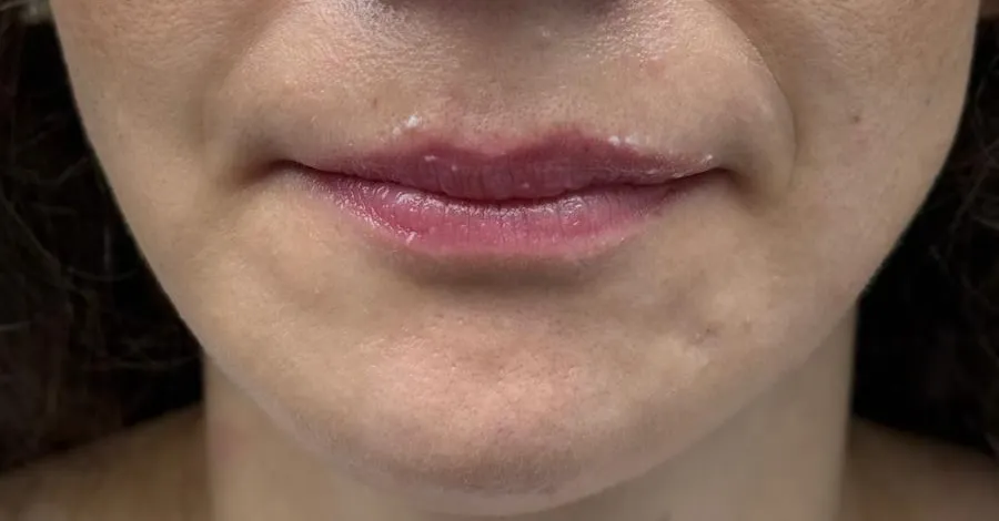 Dolgu ve Botoks - Before