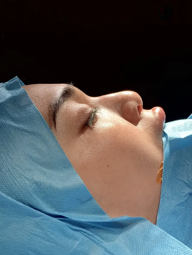 Rhinoplasty - Before