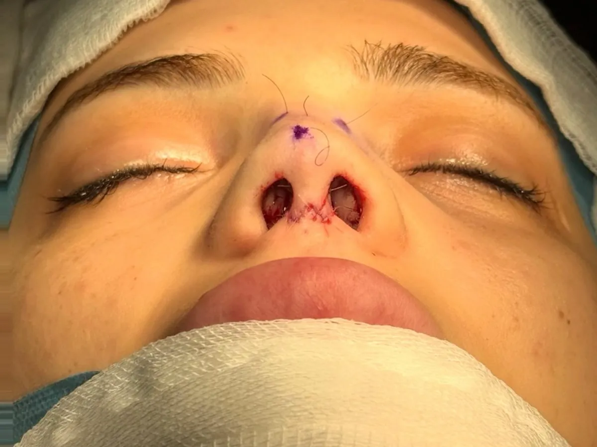 Revision Rhinoplasty - After