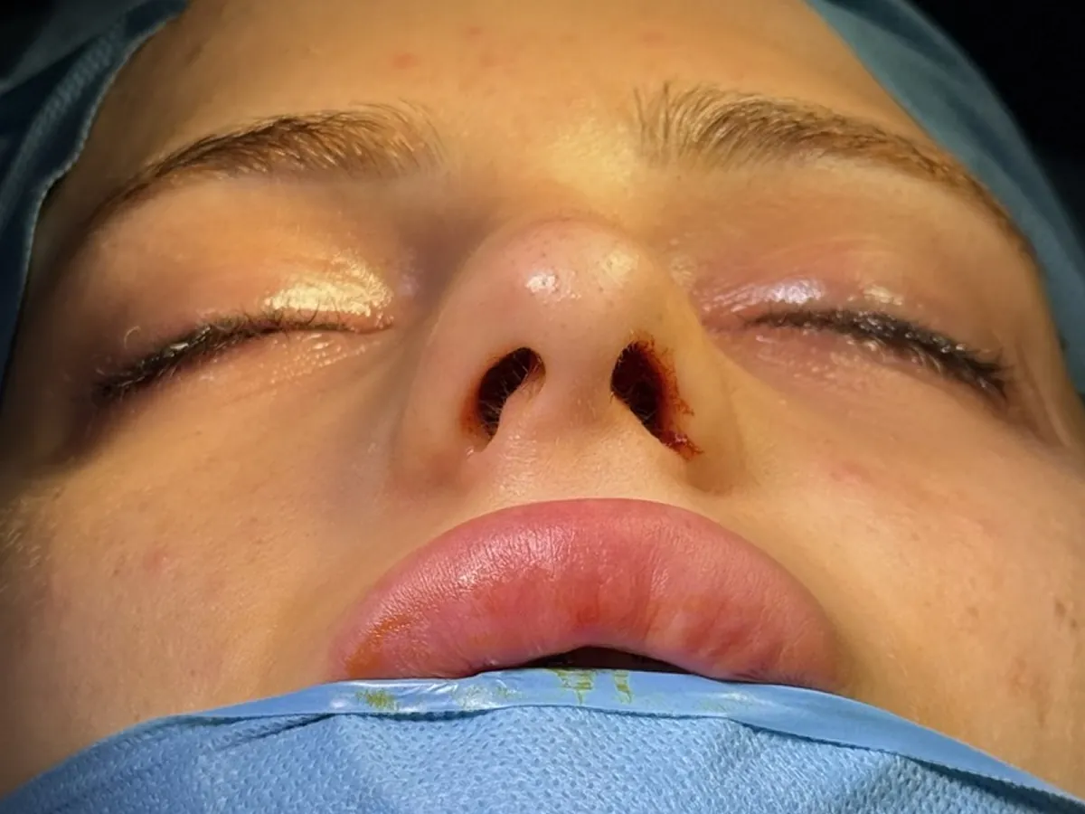 Revision Rhinoplasty - Before