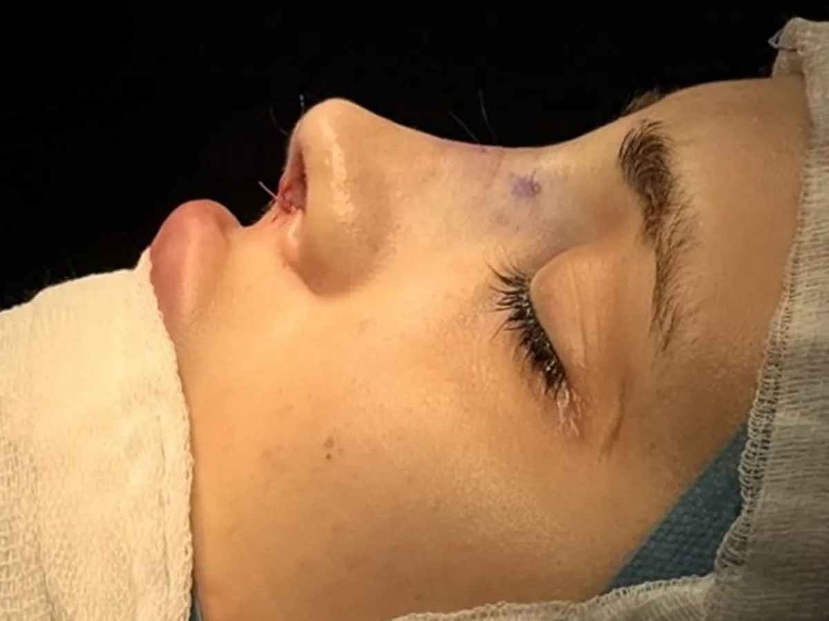 Revision Rhinoplasty - After