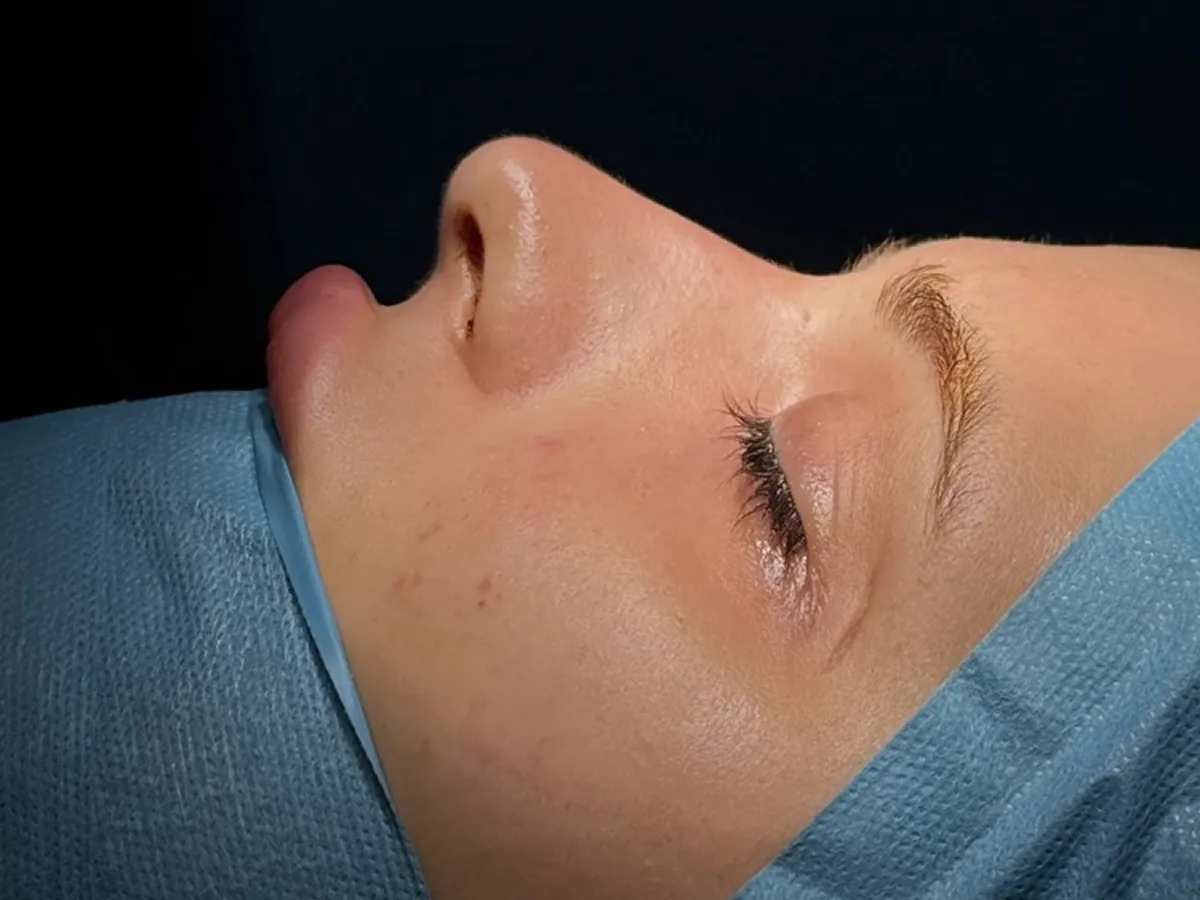 Revision Rhinoplasty - Before